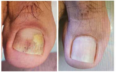 will lamisil cure toenail fungus